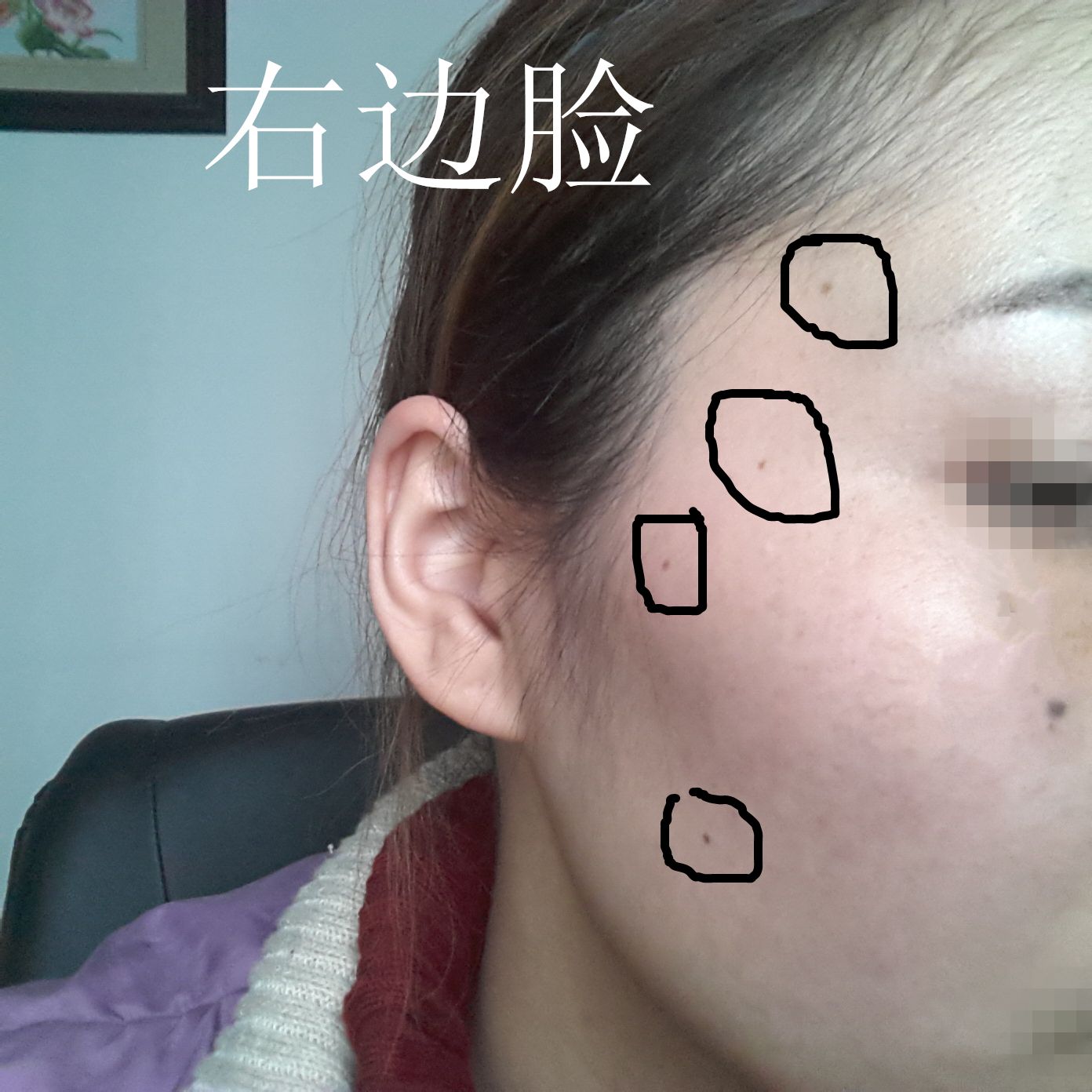 脸上长痣:脸上长黑痣的意思