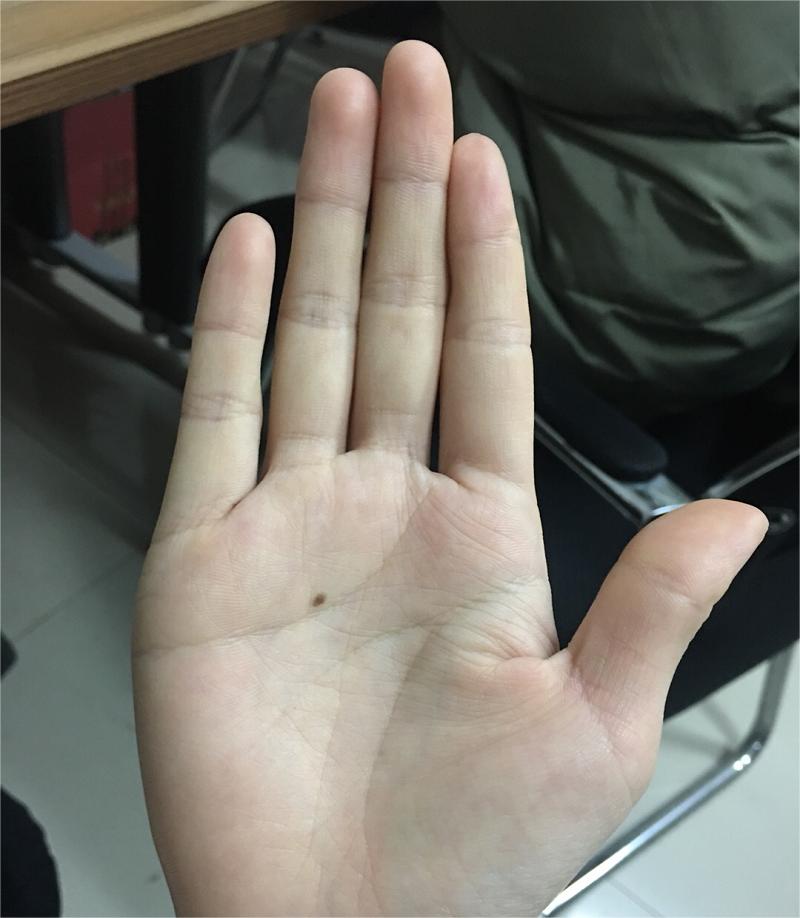 右手掌心有痣代表什么 右手掌心有痣代表什么意思