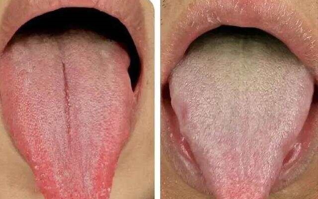 舌苔看病症大全图解 舌头看病症大全图解舌诊断